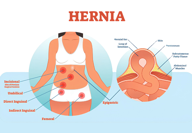 Illustration of common hernia types
